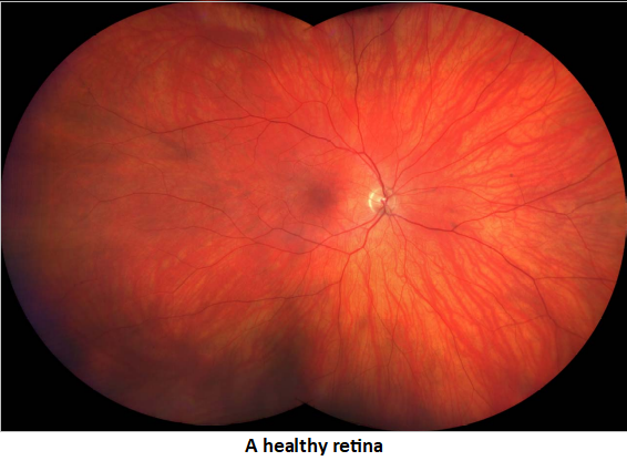 Healthy Retina